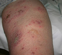 El ungüento la psoriasis volgograd